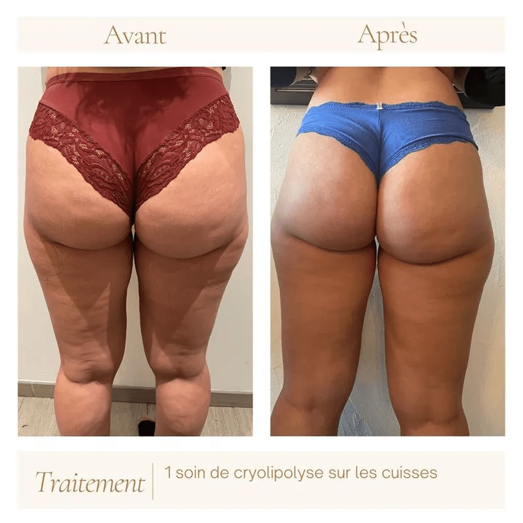 Thighs before a cryolipolysis session — photograph from the practice